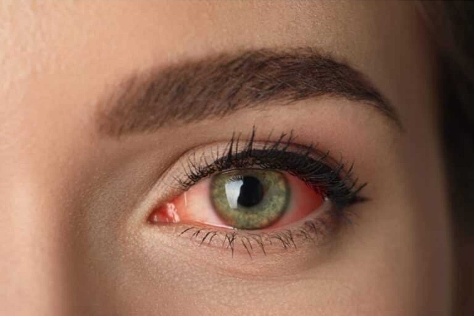 Common Eye Infections and Treatment Options